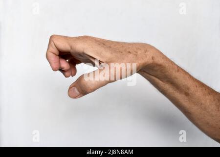 Volkmann Kontraktur im linken oberen Teil des älteren Mannes aus Südostasien. Es ist eine dauerhafte Verkürzung der Unterarmmuskulatur, die zu einem klawähnlichen Po führt Stockfoto