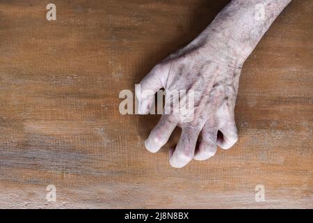 Volkmann Kontraktur im linken oberen Teil des älteren Mannes aus Südostasien. Es ist eine dauerhafte Verkürzung der Unterarmmuskulatur, die zu einem klawähnlichen Po führt Stockfoto