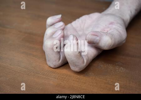 Volkmann Kontraktur im linken oberen Teil des älteren Mannes aus Südostasien. Es ist eine dauerhafte Verkürzung der Unterarmmuskulatur, die zu einem klawähnlichen Po führt Stockfoto