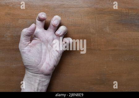 Volkmann Kontraktur im linken oberen Teil des älteren Mannes aus Südostasien. Es ist eine dauerhafte Verkürzung der Unterarmmuskulatur, die zu einem klawähnlichen Po führt Stockfoto