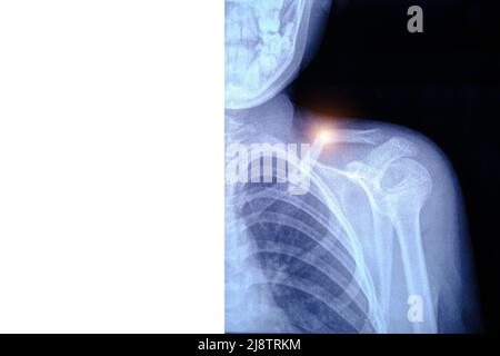 Röntgenbild gebrochener Schlüsselbeinknochen. Stockfoto