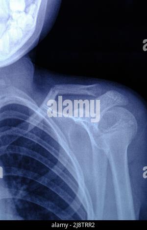 Röntgenbild gebrochener Schlüsselbeinknochen Stockfoto