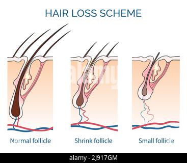 Haarausfall Schema. Verlust Haar, Wachstum Haar Problem, Gesundheit Haar. Vektorgrafik Stock Vektor