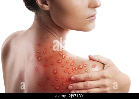 Frau und ihre Haut sind von Blasenausschlag aufgrund von Monkeypox auf weißem Hintergrund betroffen Stockfoto