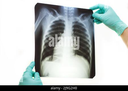 Mann Hand hält eine Lunge Radiographie isoliert auf einem weißen Hintergrund. Arzt mit Maske und Handschuhen, die auf die Röntgenaufnahme des Brustkorbs schauen Stockfoto