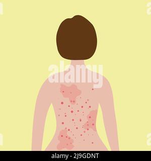 Akne auf dem weiblichen Rücken. Allergiebehandlung, Hautprobleme Konzept. Stock Vektor