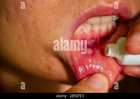 Close - up auf der Lippe mit aphthen Stomatitis Anwendung antibakterielle Creme Stockfoto