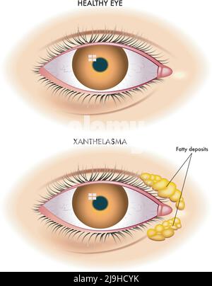 Die medizinische Abbildung zeigt den Vergleich zwischen einem normalen Auge und einem von Xanthelasma betroffenen Auge. Stock Vektor
