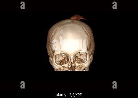 Computertomographie des Schädels mit einer gebrochenen Stirn nach dem Sturz, Schädelfraktur, 3D Computertomographie des Schädels Stockfoto