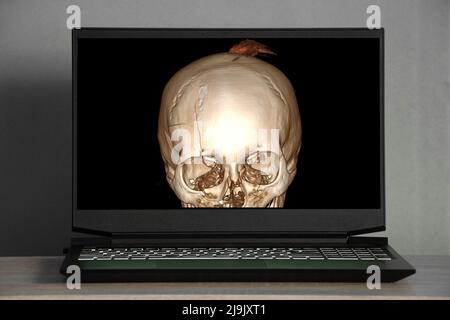 3D Computertomographie des Gehirns mit einem Bruch des frontalen Schädelteils nach einer Verletzung auf den Laptop-Bildschirmen auf dem Tisch, dem Schädel Stockfoto