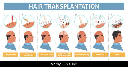 Poster mit Schritt-Info-Poster zur Haartransplantation bei Männern Stock Vektor