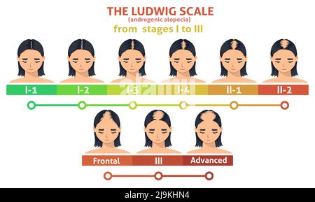 Ludwig-Skala von androgener Alopezie-Schritt-Poster Stock Vektor