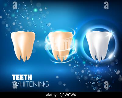 Zahnaufhellung ad Vektor realistische Illustration Stock Vektor