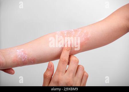 Mama schmiert Creme auf der Hand eines Kindes mit atopischer Dermatitis. Nahaufnahme der Hände Stockfoto