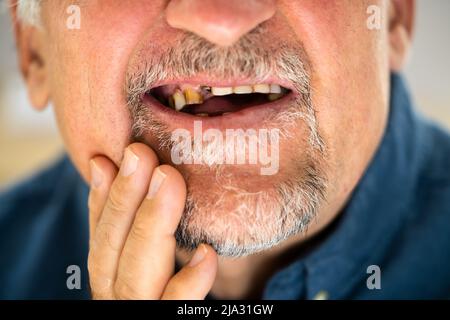 Nahaufnahme EINES Mannes Mit Zahnproblem Stockfoto