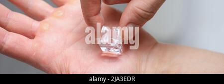 Ein Stück Eis auf der Handfläche eines Mannes, Schwielen auf seinen Händen Stockfoto