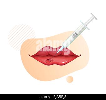 Botulinumtoxin Injection on Lips - Stock Illustration as EPS 10 File Stock Vektor