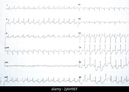 Eine positive Stress-induzierte myokardiale Ischämie mit signifikanten horizontalen ST-Depression-Veränderungen im Stress-EKG-Elektrokardiogramm-Test, Patient war Stockfoto