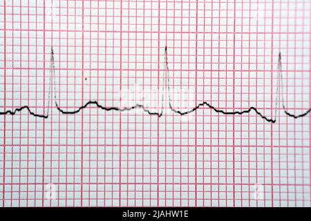 Elektrokardiogramm-EKG in einem Diagrammpapier zeigt normalen Sinus-Rhythmus, Vitalparameter und medizinisches Gesundheitssymbol, selektive Fokussierung des Elektrokardiographen-MAD Stockfoto