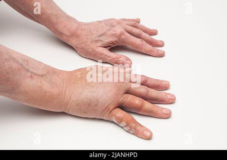 Geschwollene rechte postoperative Hand aus Dupuytrens Kontraktur mit verheilter linker postoperiverer Hand, Handflächen nach unten. Kleiner Finger auf der rechten Hand zeigt Steri-Streifen. Stockfoto