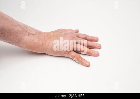 Geschwollene rechte Hand nach dem Op von Dupuytrens Kontraktur-Handfläche nach unten, mit Steristreifen. Stockfoto