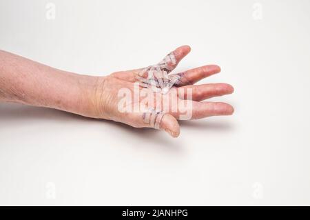 Geschwollene rechte Hand nach dem Op von Dupuytrens Kontraktur mit Steristreifen nach oben. Stockfoto