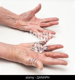 Geschwollene rechte postoperative Hand aus Dupuytrens Kontraktur mit verheilter linker postopernter Hand, Handflächen nach oben. Die rechte Hand hat Steristreifen. Stockfoto