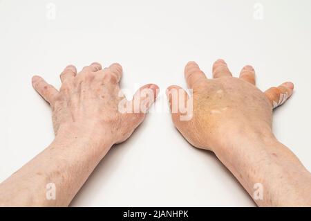 Geschwollene rechte postoperative Hand aus Dupuytrens Kontraktur mit verheilter linker postoperiverer Hand, Handflächen nach unten. Steri-Streifen befinden sich auf einem kleinen Finger der rechten Hand. Stockfoto