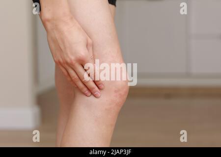 Hautallergien, Beine Haut Frauen. Nahaufnahme von roten Pusteln am Knie, einer allergischen Reaktion, die durch atopische Dermatitis verursacht wird. Ausgewählter Fokus. Stockfoto