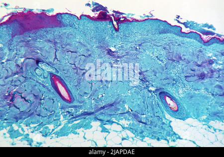 Unter einer Vergrößerung von 125X zeigte dieses Bild einen Abschnitt von Hautgewebe, der von einer Läsion auf der Haut eines Affen gewonnen wurde, die mit dem Monkeypox-Virus infiziert war. Die Probe wurde am 4. Tag der Hautausschlag-Entwicklung gewonnen. Eine optimierte und verbesserte Version eines Bildes, das von den US Centers for Disease Control and Prevention / Credit CDC erstellt wurde Stockfoto