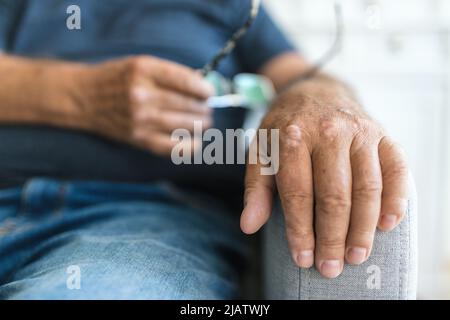 Älterer Mann, der an Psoriasis leidet, Nahaufnahme der Hände Stockfoto