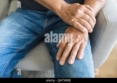 Älterer Mann, der an Psoriasis leidet, Nahaufnahme der Hände Stockfoto