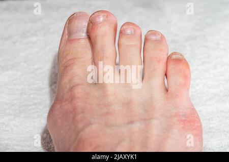 Weibliche Beine mit natürlichen gebrochenen Nägeln. Weibliche Beine mit schiefen Zehen und Bunion. Behandlung und Prävention von Hallux Valgus. Fußpflegekonzept Stockfoto