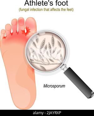 Fußpilz. Pilzinfektion, die die Füße betrifft. Nahaufnahme von Microsporum-Pilzen. vektordarstellung Stock Vektor