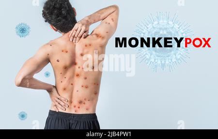 Menschen mit Monkeypox auf isoliertem Hintergrund, Eine Person von hinten mit Monkeypox auf seinem Körper, Monkeypox-Virus-Konzept, Monkeypox-Virus Ausbruch Stockfoto