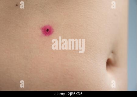 Nahaufnahme einer entfernten Warze am Bauch einer Frau. Humanes Papillomavirus nach dem Brennen. Stockfoto