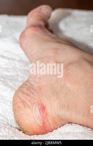 Fuß mit Hornhaut auf einem weißen Handtuch, Nahaufnahme. Rote Schmerzen am Bein durch das Tragen von Schuhen. Blutiger Callus an der Ferse. Trockene Haut an den Füßen mit Rissen, Peeling Stockfoto