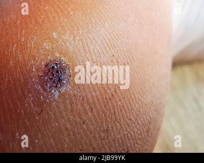 Plantar schwarze Warze, Hautproblem aus nächster Nähe, HPV Stockfoto