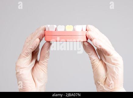 Hände in Handschuhe mit Kiefer Modell mit gelbem Zahn. Zahnbelag, Hohlraum, Zerfall. Schlechte Mundhygiene, Zahnprobleme, Stomatologie Konzept. Hochwertige Fotos Stockfoto