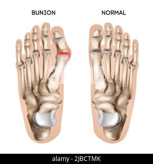 Realistische Bunion Fuß Komposition mit editierbaren Textunterschriften und Ansichten von normalen und beschädigten menschlichen Fußspuren Vektor-Illustration Stock Vektor