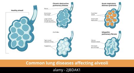 Häufige Alveolen-Schäden. Unterschiede zwischen Veränderungen durch Lungenerkrankungen: Chronisch obstruktive Atemwegserkrankung, Asthma Stock Vektor