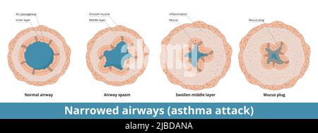 Stadien der Atemwegsverengung während eines Asthmaanfalls mit Schleimstopfen. Glatte Muskelschicht geht in Krämpfe, mittlere Schicht schwillt an, übermäßiger Schleim Stock Vektor