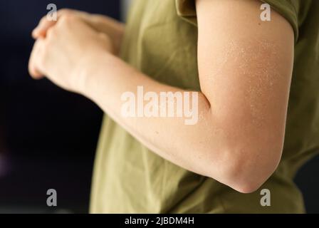 Peeling Haut an der Schulter von Sonnenbrand Wirkung auf den Körper der jungen Frau. Mädchen mit rot sonnenverbrannten Haut Konzept Stockfoto