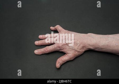 Dupuytrens Kontraktur, rechte Hand, Handfläche nach unten, auf grauem Hintergrund. Stockfoto