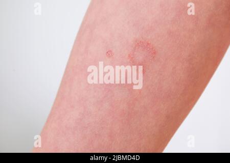 Das Kind hat allergische Kontaktdermatitis auf der Haut. Stockfoto