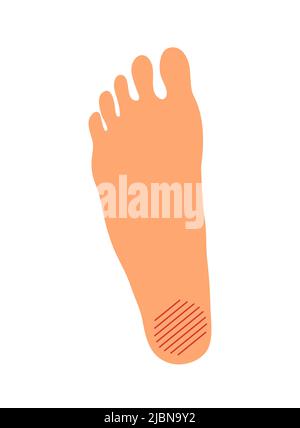 Plantar fasciitis Problem auf dem weiblichen Fuß. Orthopädische Deformität von Gelenk und Knochen. Frauenbein. Krankheit, Schmerz und Heilung. Gesundheitswesen. Vektor-il Stock Vektor