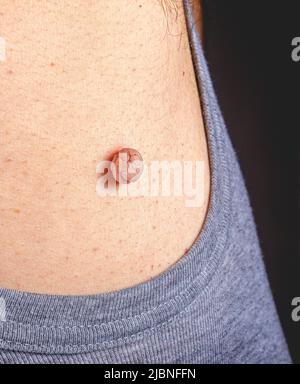 Nahaufnahme eines Hautfleck oder Hautmaules auf einem menschlichen Körper vor der Behandlung durch einen medizinischen Dermatologen mit flüssigem Stickstoff. Entfernen von Hautmole-Tags. Dermatolog Stockfoto