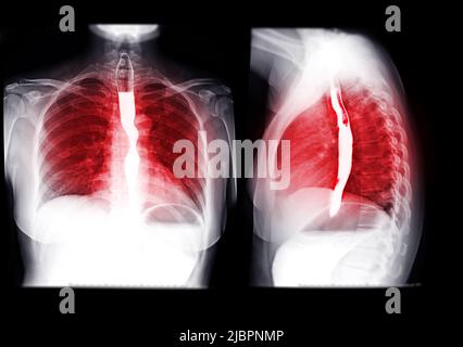 Sammlung von Esophagramm- oder Bariumschlucken mit Speiseröhre zur Diagnose GERD- oder gastroösophagealer Refluxkrankheit oder Ösophaguskrebs. Stockfoto