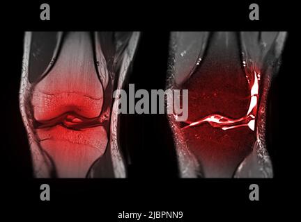 Magnetresonanztomographie des Knies oder MRT-kniekoronale Ansicht zur Erkennung von Rissen oder Verstauchungen des vorderen Kreuzbandes (ACL). Stockfoto