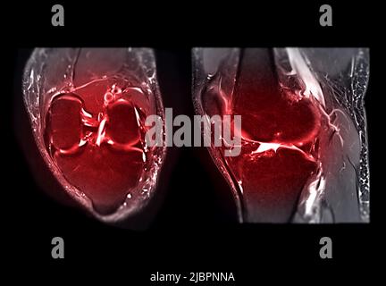 Magnetresonanztomographie des Knies oder MRT-Knie T2W Fettsuppreesion zum Nachweis von Rissen oder Verstauchungen des vorderen Kreuzbandes (ACL). Stockfoto